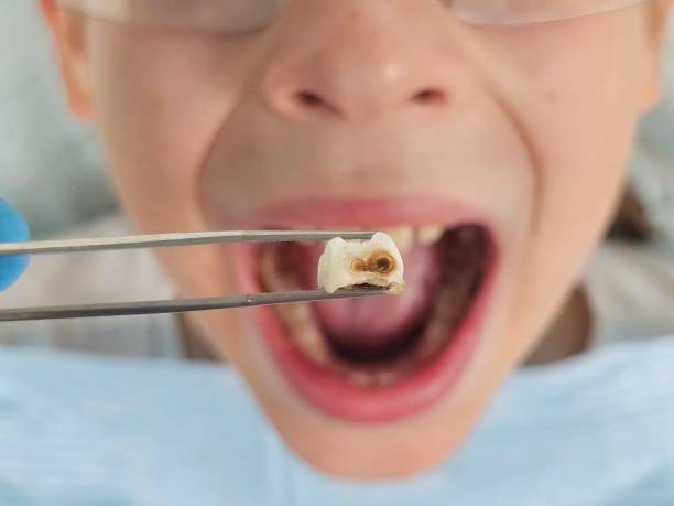 Best Emergency Dental Care for Broken or Chipped Teeth in Polo, IL